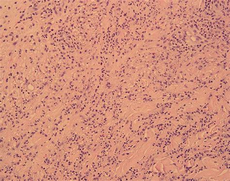 Palisaded Neutrophilic Granulomatous Dermatitis With Concomitant