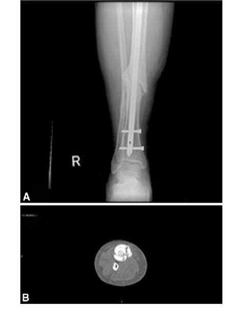 A B Ap Of The Distal Tibia And Fibula A And Axial Ct Image At The
