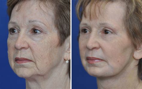 Facelift Before And After Photos Annapolis Non Surgical Facelift