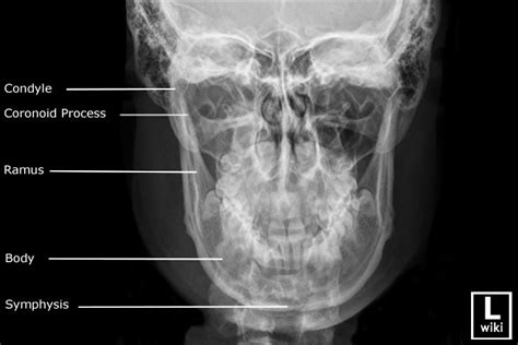 Mandible Radiographic Anatomy Wikiradiography Facial Bones