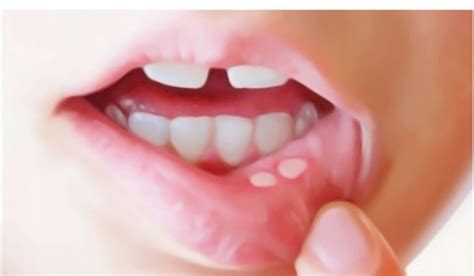 An Uncomfortable Ulcer On The Inside Of The Mouth Canker Sores