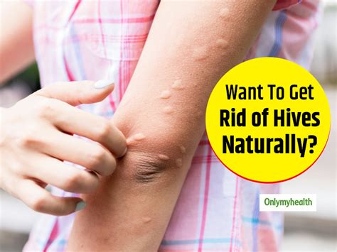 Irritated With Hives Try These Effective Natural Remedies Irritated