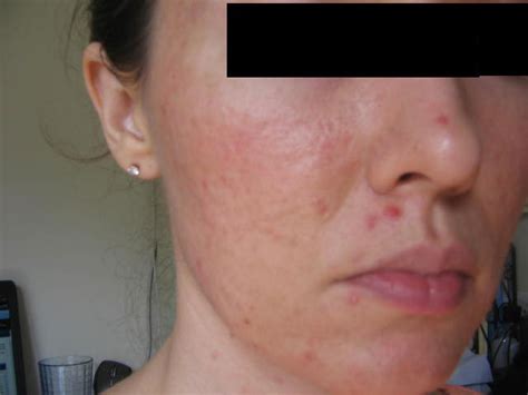 Treatments For Acne Inflammatory Vulgaris