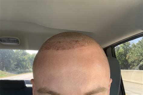 New Hairline Seems Very Uneven Is This Normal Will It Look Better When It Grows In R