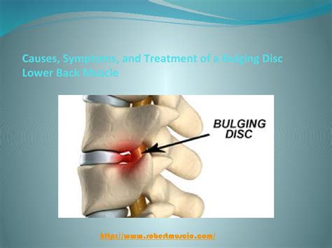 Causes Symptoms And Treatment Of A Bulging Disc Lower Back Muscle By