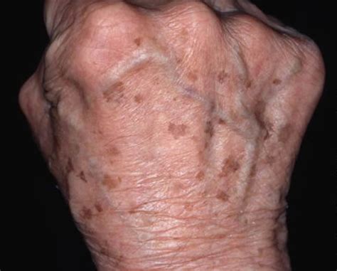 Aprenda A Tratar O Envelhecimento Das Mãos Esteticista Como Você