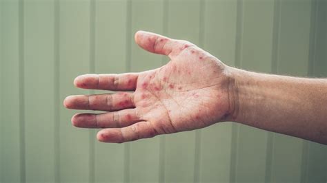 Hand Foot And Mouth Disease Symptoms Prevention And Hfmd Treatment