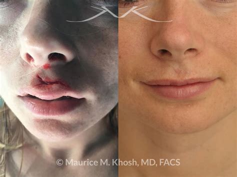 New York Facial Plastic Surgery Skin Laceration Repair Before And After