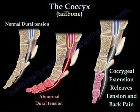 Coccyx Tailbone Pain Coccydynia Everything You Need To Know Dr