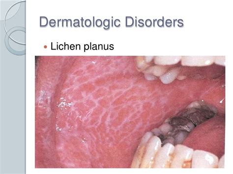 Oral Cavity Lesions