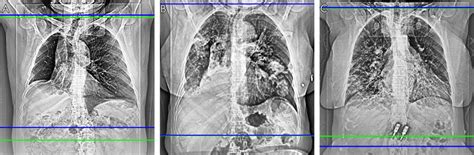 Scan Range Delimitations Of The Radiologists Green And The Network