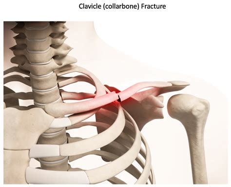 Clavicle Collarbone Fractures Sydney Shoulder Unit
