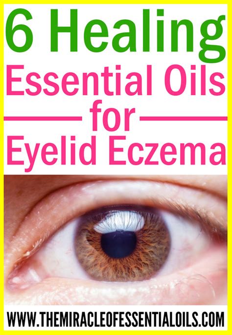 These creams are also helpful for dry itchy skin, redness, rosacea, psoriasis, shingles, rashes, sunburns. 6 Essential Oils for Eczema on Eyelids (plus Healing Cream ...