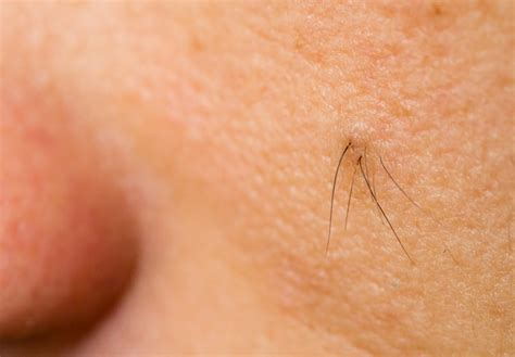 Ingrown Hairs What Are They And How To Treat Excellent Esthetics