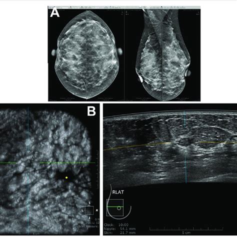Fibroadenoma Breast Us Shows An Oval Circumscribed Hypoechoic Mass