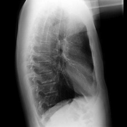 More Black Sign Radiology Reference Article Radiopaedia Org