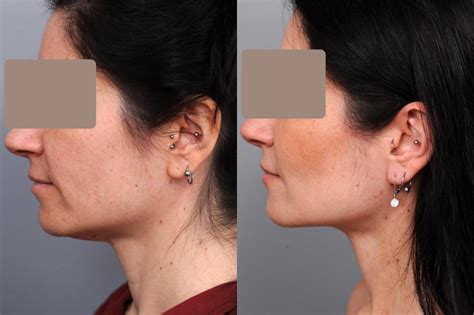 Smartlipo™ Neck Liposuction In New York Dr Sterry