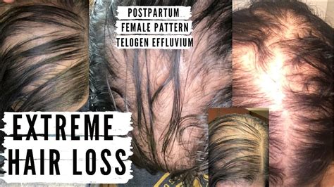 Extreme Hair Loss Postpartum Hair Loss Telogen Effluvium Female Pattern Hair Loss Youtube