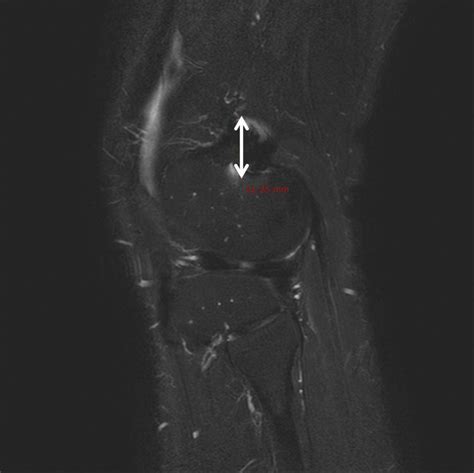 Reduced Metallic Artefacts In 3 T Knee Mri Using Fast Spin Echo Multi