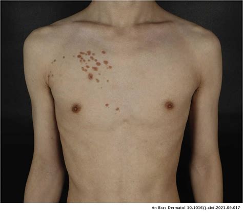 Unilateral Linear Syringoma On The Right Chest And Arm Anais