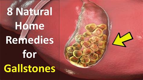 How To Get Rid Of Gallstones Without Surgery 8 Natural Home Remedies