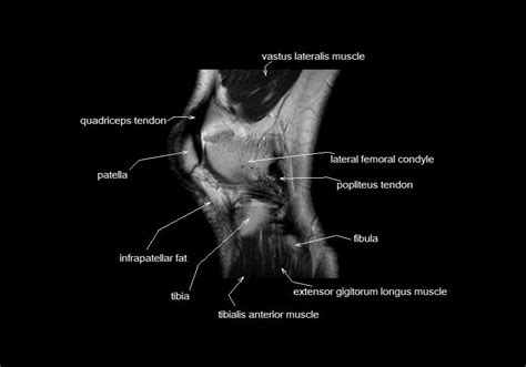 Magnetic resonance imaging (mri scan): mri knee anatomy | knee sagittal anatomy | free cross sectional anatomy | | Knee mri, Mri, Anatomy