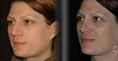 Rhinoplasty Recovery Timeline The Leading Cosmetic Surgery Service In