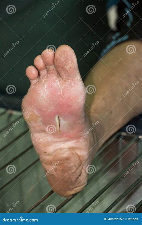 Wound Of Diabetic Foot Stock Image Image Of Scar Painful 48522157