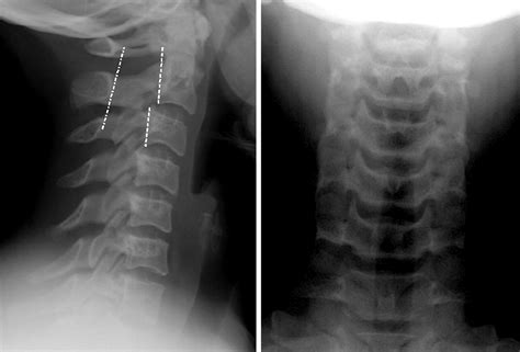 assessment    normal cervical spine radiograph   pseudosubluxation   adult