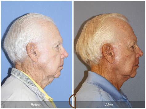 Neck Lift Before And After Photos Patient 50 Dr Kevin Sadati