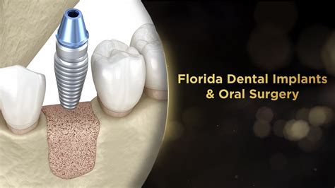 Single Dental Implant Procedure With Bone Grafting Youtube