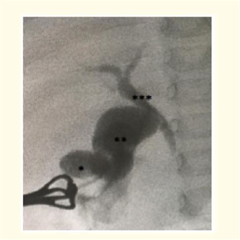 Intraoperative Cholangiography Showing The Gallbladder The Cystic