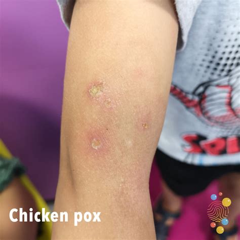 Chicken Pox Symptoms On Black Skin Bmp Klutz