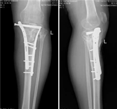 A Man With An Open Fracture Of The Left Tibial Plateau Postoperative