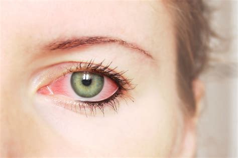 Pink Eye Causes And Treatment