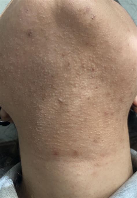 What Are These Bumps On My Neck Acne