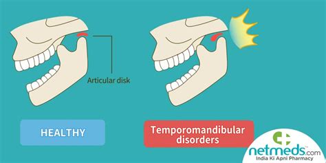 Temporomandibular Joint Disorders Symptoms Causes And Treatment