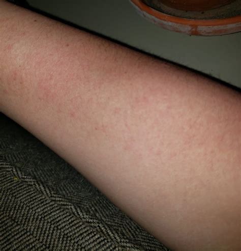 Pmle Sun Allergy Rash Pictures Life Without Dressing