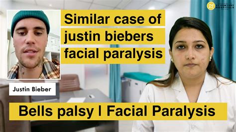 Similar Case Of Justin Biebers Facial Paralysis Bells Palsy Facial Paralysis Bell S Palsy
