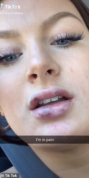 How Do You Prevent Bruising After Lip Fillers Wallpaperist