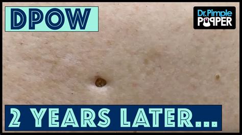 Flip It And Reverse It Blackhead Extraction Dilated Pore Of Winer Youtube