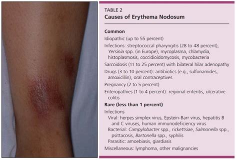 Causes Of Erythema Nodosum Common Idiopathic Up Grepmed