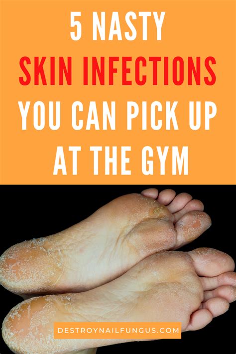 How To Avoid Getting Fungus From Gym Your Ultimate Guide