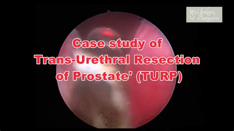 Transurethral Resection Of Prostate In Bangalore TURP Operation