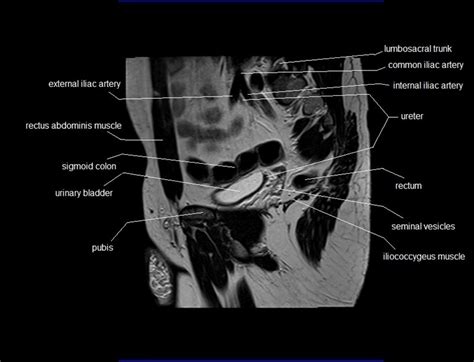 Pelvic Muscle Anatomy Mri