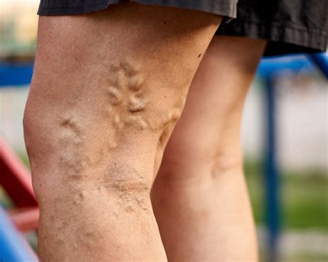 Vein Treatment Specialist Signs Of Vein Problems And Why You Should Visit A Vein Doctor