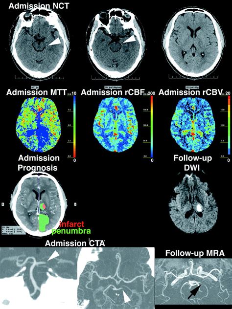 Comparative Overview Of Brain Perfusion Imaging Techniques Stroke