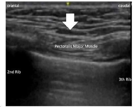 An Ultrasound Image Of The Selective Supraclavicular Nerve Block An