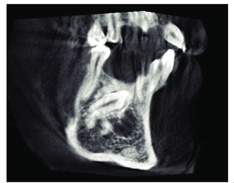 Cbct Sagital View Showing Impacted Mandibular Right Canine And A