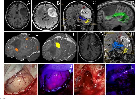 Figure 1 From 5 Ala Guided Tumor Resection During Awake Speech Mapping